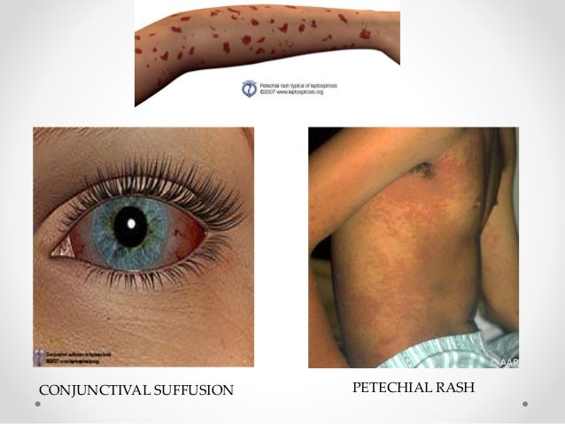 Leptospirosis 2015
