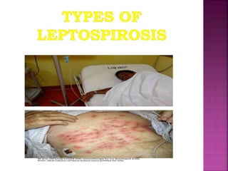Leptospirosis powerpoint