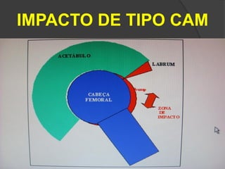 IMPACTO DE TIPO CAM
 