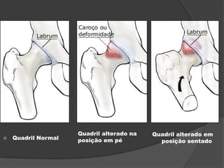 Quadril alterado na   Quadril alterado em
   Quadril Normal   posição em pé           posição sentado
 