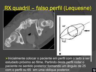 RX quadril – falso perfil (Lequesne)



                                                   65º



                                                         65º




Inicialmente colocar o paciente em perfil com o lado a ser
estudado próximo ao filme. Partindo deste perfil rodar o
paciente no sentido posterior formando um ângulo de 25
                                         Boa mobilização
com o perfil ou 65 em uma oblíqua posterior.
 