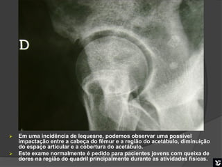    Em uma incidência de lequesne, podemos observar uma possível
    impactação entre a cabeça do fêmur e a região do acetábulo, diminuição
    do espaço articular e a cobertura do acetábulo.
   Este exame normalmente é pedido para pacientes jovens com queixa de
                                                    Boa mobilização
    dores na região do quadril principalmente durante as atividades físicas.
 