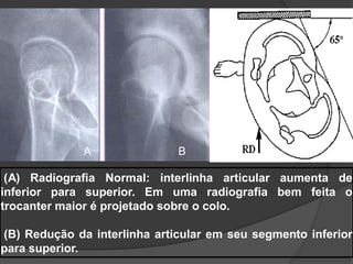 A               B

 (A) Radiografia Normal: interlinha articular aumenta de
inferior para superior. Em uma radiografia bem feita o
trocanter maior é projetado sobre o colo.

(B) Redução da interlinha articular em seu segmento inferior
para superior.
 