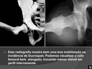    Esta radiografia mostra bem uma boa mobilização na
    incidência de Ducroquet. Podemos visualizar o colo
    femoral bem alongado, trocanter menor visível em
    perfil internamente.
                                      Boa mobilização
 