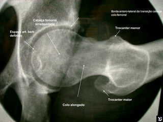 Borda antero-lateral da transição cabeça
                                                 colo femoral
              Cabeça femoral
               arredondada
                                                    Trocanter menor
Espaço art. bem
definido




                                               Trocanter maior
                               Colo alongado


                                               Boa mobilização
 
