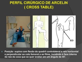 PERFIL CIRÚRGICO DE ARCELIN
               ( CROSS TABLE)




   Posição supina com flexão do quadril contralateral e raio horizontal
    e perpendicular ao colo femoral e ao filme, incidindo á face interna
    da raiz da coxa que se quer avaliar em um ângulo de 45°.
 