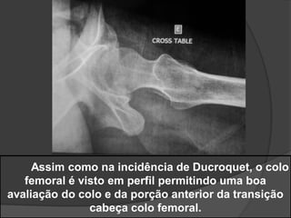 Assim como na incidência de Ducroquet, o colo
   femoral é visto em perfil permitindo uma boa
avaliação do colo e da porção anterior da transição
               cabeça colo femoral.
 
