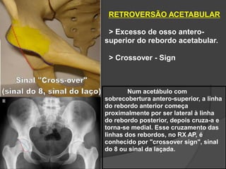 RETROVERSÃO ACETABULAR

 > Excesso de osso antero-
superior do rebordo acetabular.

 > Crossover - Sign



        Num acetábulo com
sobrecobertura antero-superior, a linha
do rebordo anterior começa
proximalmente por ser lateral à linha
do rebordo posterior, depois cruza-a e
torna-se medial. Esse cruzamento das
linhas dos rebordos, no RX AP, é
conhecido por "crossover sign", sinal
do 8 ou sinal da laçada.
 