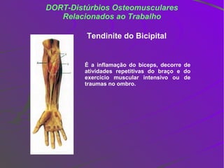 DORT-Distúrbios Osteomusculares
   Relacionados ao Trabalho

         Tendinite do Bicipital


         É a inflamação do bíceps, decorre de
         atividades repetitivas do braço e do
         exercício muscular intensivo ou de
         traumas no ombro.
 