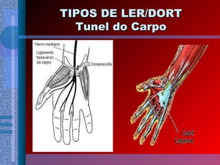TIPOS DE LER/DORTTIPOS DE LER/DORT
Tunel do CarpoTunel do Carpo
 