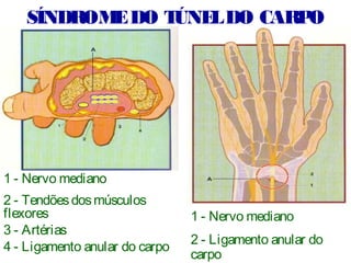 1 - Nervo mediano
2 - Ligamento anular do
carpo
1 - Nervo mediano
2 - Tendõesdosmúsculos
flexores
3 - Artérias
4 - Ligamento anular do carpo
SÍNDROMEDO TÚNELDO CARPO
 