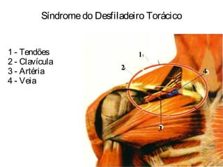 Síndromedo Desfiladeiro Torácico
1 - Tendões
2 - Clavícula
3 - Artéria
4 - Veia
4
3
2
1
 
