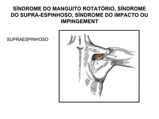 SÍNDROME DO MANGUITO ROTATÓRIO, SÍNDROME
DO SUPRA-ESPINHOSO, SÍNDROME DO IMPACTO OU
IMPINGEMENT
SUPRAESPINHOSO
 