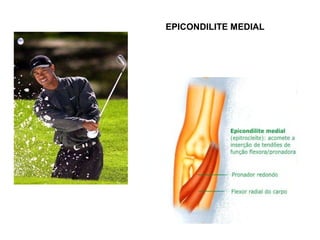 EPICONDILITE MEDIAL
 