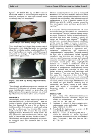 www.ejpmr.com 475
Yadav et al. European Journal of Pharmaceutical and Medical Research
kg/mm2
. HIV ELISA, Hbs Ag, anti HCV were non
reactive. On the basis of above investigation diagnosis of
tubercular meningitis was made and treatment started
accordingly along with antiepileptics.
Figure 2 Right hand showing multiple bony swelling
X-ray of right leg (Fig-3) showed dense irregular cortical
hyperostosis , which looks like candle wax, extending
along tibia of right leg resulting in deformity of bone. X-
ray of right hand showed irregular cortical thickening of
metacarpals and phalanges . X-ray picture of left upper
and lower limb appear normal.
Figure 3 X ray both legs showing subperiosteal bony
growths
The orthopedic and radiology experts were consulted and
diagnosis of Leri disease with tubercular meningitis was
made. Antitubercular treatment was given along with
bishphosphonate. Some operative treatment was adviced
by orthopedicians but patient refuses to take treatment.
DISCUSSION
Melorheostosis is a rare chronic bone disorder which was
first described in 1922 by Leri and Joanny[1]
. Male and
female are equally affected, and no hereditary features
have been discovered. The onset of this rare diseases is
insidious, and the first symptom is usually dull aching
pain due to subperiosteal bone formation. Skin become
rough, hard and in 17% of cases that may include
hyperpigmentation. Melorheostosis mainly affects, the
long bones of the upper and lower limb, and also short
bones of hand and foot, but rarely the axial skeleton.[2,3]
Melorheostosis may present in a monostotic, polyostotic,
or monomelic form. The monomelic form is most
common.[4]
The most accepted hypothesis was given by Murray and
McCredie1979.[5]
was that, embryonic infection of nerve
root causes neural scarring and segmental bone sclerosis
responsible for melorheostosis. One possible etiology of
melorheostosis is a loss of function mutation in the
LEMD3 gene (12q12–12q14.3), a protein involved in
bone morphogenic protein and tumor growth factor-β
signaling.[6]
It is associated with vascular malformations, soft tissue
masses adjacent to the affected bone and scleroderma of
the overlying skin.[7]
Routine laboratory findings usually
are normal. Histological findings are usually nonspecific
and often show dense bone formation, a mixture of
mature and immature bone elements.[7]
Osteoclastic
activity is not a prominent feature; however, osteoblastic
activity along the margins of osteons is common.[8]
Treatment is mainly symptomatic. Most patient receives
nonoperative treatment. Operative treatment consists of
tendon lengthening, excision of hyperostotic bone,
osteotomies ,sympathectomy and amputation[3]
.Bisphosphonate are commonly use.[3]
Potential causes of
the bone pain in melorheostosis include increased
osteoclastic bone resorption and activation of pain
receptors, raised intraosseous pressure and increased
vascularity secondary to hyperosteosis and soft tissue
involvement around joints. Thus, bisphosphonate
treatment via a number of mechanisms would be
expected to reduce inflammatory bone pain and
symptoms in melorheostosis. Bisphosphonates inhibit
osteoclast mediated bone resorption by direct and
indirect actions on osteoblasts and macrophages and
bone vascularity. They have been shown to decrease
bone pain, slow progression of bone lesion.[9]
The
prognosis of a patient with melorheostosis is variable and
depends on the anatomical location, extension into the
soft tissues, and soft tissue changes. Melorheostosis does
not shorten life span, however, morbidity may be
considerable. The disease exhibits a slow, chronic
course, with periods of exacerbation and arrest.
Recurrence usually is expected after operative
excision.[10]
REFERENCES
1. Leri A, Joanny J. Une affection non décrite des os
hyperostose “en coulée” sur toute la longeur d'un
member ou “melorhéostose.” Bull Mem Soc Med
Hosp Paris. 1922; 46: 1141–1145.
2. Greenspan A, Azouz EM. Bone dysplasia series:
melorheostosis: review and update. Can Assoc
Radiol J. 1999; 50: 324–330.
3. Freyschmidt J.: Melorheostosis: a review of 23
cases. Eur Radiol 2001; 11: 474–9
4. Zeiller SC, Vaccaro AR, Wimberley DW, Albert TJ,
Harrop JS, Hilibrand AS. Severe myelopathy
resulting from melorheostosis of the cervicothoracic
spine: a case report. J Bone Joint Surg Am. 2005;
87: 2759–2762.
 