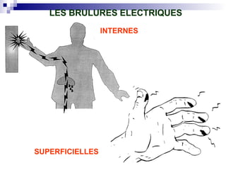 LES BRULURES ELECTRIQUES
SUPERFICIELLES
INTERNES
 