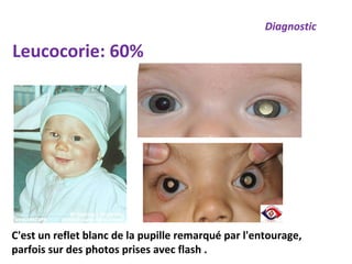 Diagnostic
Leucocorie: 60%
C'est un reflet blanc de la pupille remarqué par l'entourage,
parfois sur des photos prises avec flash .
 