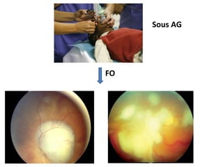 FO
Sous AG
 