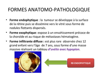 FORMES ANATOMO-PATHOLOGIQUE
• Forme endophytique : la tumeur se développe à la surface
de la rétine puis se dissémine vers le vitré sous forme de
nodules flottants dispersés.
• Forme exophytique: expose à un envahissement précoce de
la choroïde et au risque de métastases hématogène.
• Forme infiltrante diffuse : est plus rare observée chez 12
grand enfant vers l‘âge de 7 ans, sous forme d’une masse
massive réalisant un tableau d’uvéite avec hypopion.
RB ENDOPHYTIQUE
 