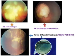 RB endophytique
RB exophytique juxtapapillaire.
forme diffuse infiltrativae( nodule rétinien)
 