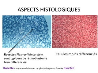 ASPECTS HISTOLOGIQUES
Rosettes Flexner-Winterstein
sont typiques de rétinoblastome
bien différenciée
Cellules moins différenciés
Rosette= tentation de former un photorécepteur  mais avortée
 