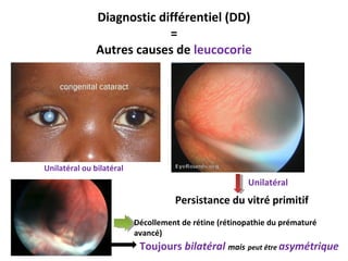 Diagnostic différentiel (DD)
=
Autres causes de leucocorie
Unilatéral ou bilatéral
Persistance du vitré primitif
Unilatéral
Décollement de rétine (rétinopathie du prématuré
avancé)
Toujours bilatéral mais peut être asymétrique
 