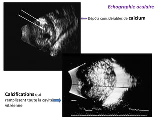Dépôts considérables de calcium
Calcifications qui
remplissent toute la cavité
vitréenne
Echographie oculaire
 
