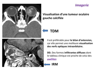 Imagerie
Visualisation d’une tumeur oculaire
gauche calcifiée
TDM
Il est préférable pour le bilan d’extension,
car elle permet une meilleure visualisation
des nerfs optiques intraorbitaire.
DD. Des formes infiltrantes diffuses dont
le tableau clinique est proche de celui des
uvéites
IRM
 