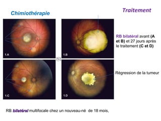 RB bilatéralbilatéral multifocale chez un nouveau-né de 18 mois,
Chimiothérapie
RB bilatéral avant (A
et B) et 27 jours après
le traitement (C et D)
Régression de la tumeur
Traitement
 