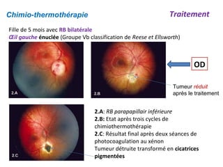 Chimio-thermothérapie Traitement
Fille de 5 mois avec RB bilatérale
Œil gauche énuclée (Groupe Vb classification de Reese et Ellsworth)
OD
Tumeur réduit
après le traitement
2.A: RB parapapillair inférieure
2.B: Etat après trois cycles de
chimiothermothérapie
2.C: Résultat final après deux séances de
photocoagulation au xénon
Tumeur détruite transformé en cicatrices
pigmentées
 