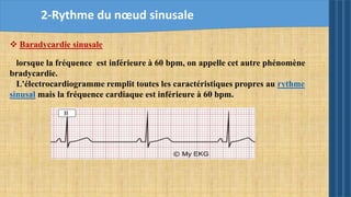  Baradycardie sinusale
lorsque la fréquence est inférieure à 60 bpm, on appelle cet autre phénomène
bradycardie.
L'électrocardiogramme remplit toutes les caractéristiques propres au rythme
sinusal mais la fréquence cardiaque est inférieure à 60 bpm.
2-Rythme du nœud sinusale
 