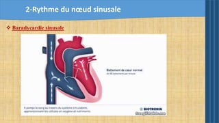  Baradycardie sinusale
2-Rythme du nœud sinusale
 
