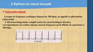  Tachycardie sinusale
Lorsque la fréquence cardiaque dépasse les 100 bpm, on appelle ce phénomène
tachycardie
L'électrocardiogramme remplit toutes les caractéristiques décrites,
correspondantes au rythme sinusal, mais la fréquence qu'il affiche est supérieure à
100 bpm.
2-Rythme du nœud sinusale
 