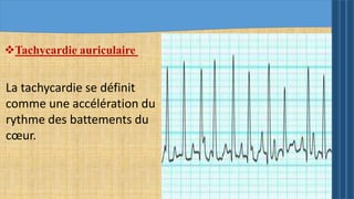Tachycardie auriculaire
La tachycardie se définit
comme une accélération du
rythme des battements du
cœur.
 