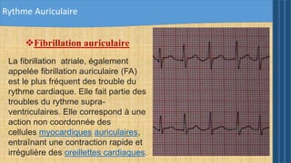 Rythme Auriculaire
Fibrillation auriculaire
La fibrillation atriale, également
appelée fibrillation auriculaire (FA)
est le plus fréquent des trouble du
rythme cardiaque. Elle fait partie des
troubles du rythme supra-
ventriculaires. Elle correspond à une
action non coordonnée des
cellules myocardiques auriculaires,
entraînant une contraction rapide et
irrégulière des oreillettes cardiaques.
 