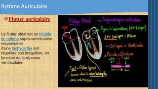 Rythme Auriculaire
Flutter auriculaire
Le flutter atrial est un trouble
du rythme supra-ventriculaire
responsable
d'une tachycardie soit
régulière soit irrégulière, en
fonction de la réponse
ventriculaire
 