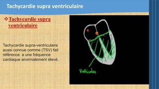 Tachycardie supra ventriculaire
Tachycardie supra-ventriculaire
aussi connue comme (TSV) fait
référence a une fréquence
cardiaque anormalement élevé.
Tachycardie supra
ventriculaire
 