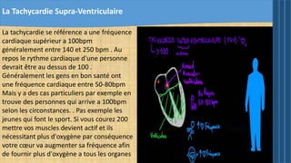 La Tachycardie Supra-Ventriculaire
La tachycardie se référence a une fréquence
cardiaque supérieur a 100bpm
généralement entre 140 et 250 bpm . Au
repos le rythme cardiaque d'une personne
devrait être au dessus de 100 .
Généralement les gens en bon santé ont
une fréquence cardiaque entre 50-80bpm
Mais y a des cas particuliers par exemple en
trouve des personnes qui arrive a 100bpm
selon les circonstances. . Pas exemple les
jeunes qui font le sport. Si vous courez 200
mettre vos muscles devient actif et ils
nécessitant plus d'oxygène par conséquence
votre cœur va augmenter sa fréquence afin
de fournir plus d'oxygène a tous les organes
 