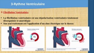 3-Rythme Ventriculaire
 Fibrillation Ventriculaire
 La fibrillation ventriculaire est une dépolarisation ventriculaire totalement
désorganisée et anarchique
 Son seul traitement est l’application d’un choc électrique sur le thorax
 