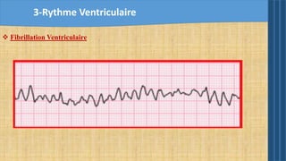 3-Rythme Ventriculaire
 Fibrillation Ventriculaire
 