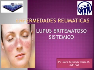 LUPUS ERITEMATOSO 
SISTEMICO 
IPG María Fernanda Tejada M. 
20817025 
 