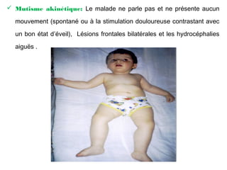  Mutisme akinétique: Le malade ne parle pas et ne présente aucun
mouvement (spontané ou à la stimulation douloureuse contrastant avec
un bon état d’éveil), Lésions frontales bilatérales et les hydrocéphalies
aiguës .
 