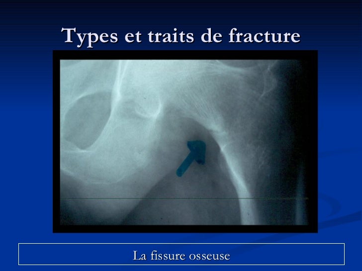 Fracture Rocher Fracture Osseuse Du Rocher Chirurgie – ERPM