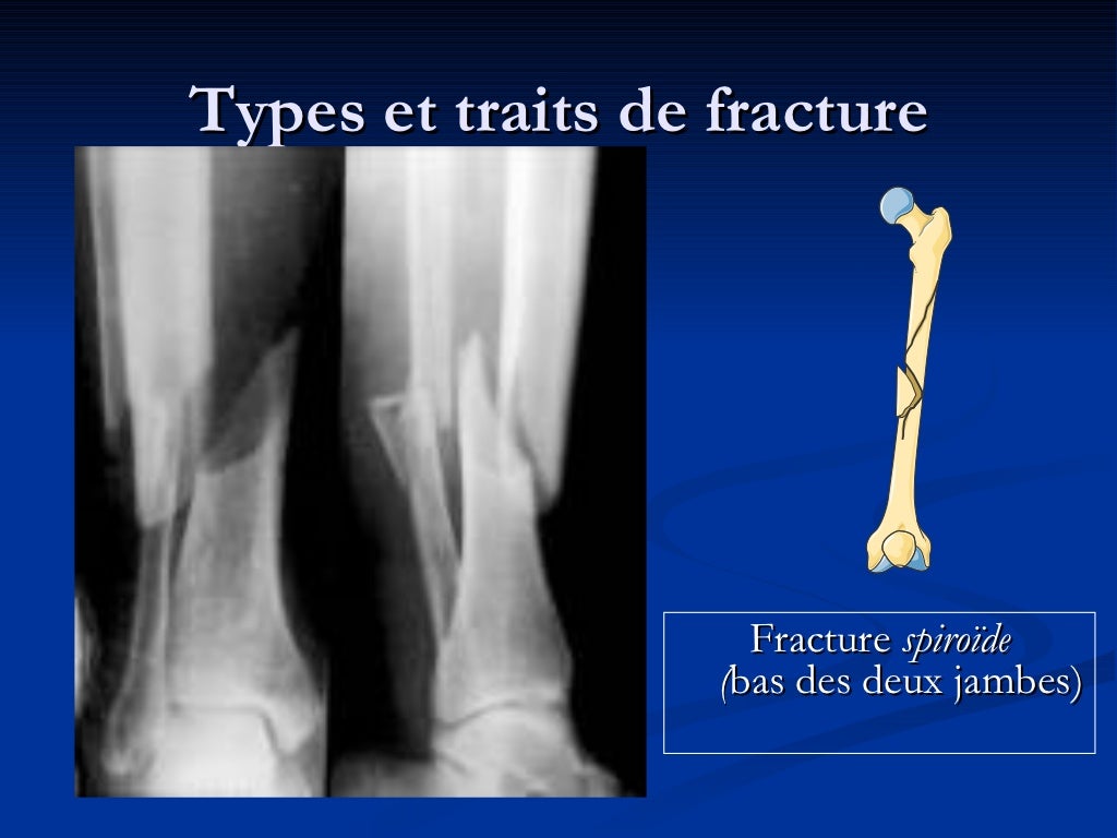 Les fractures osseuses