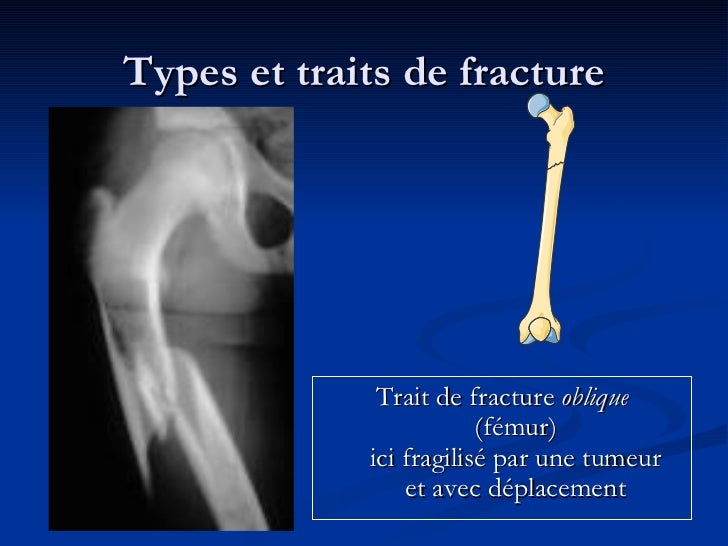 Les fractures osseuses