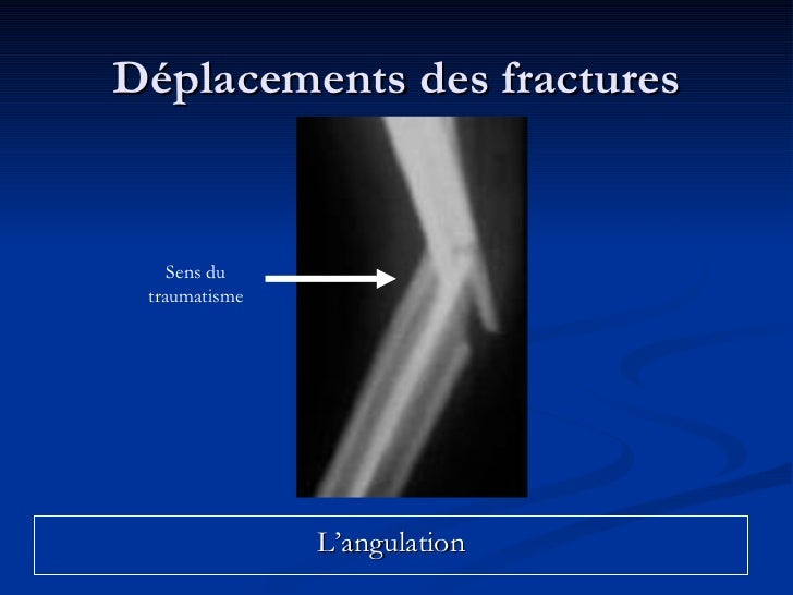 Fracture Rocher Fracture Osseuse Longitudinale – Fracture Du Rocher Symptômes – GIMR