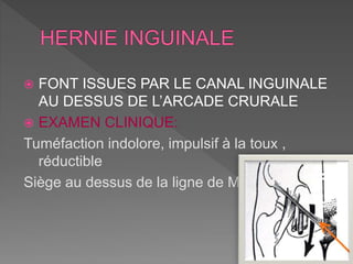  FONT ISSUES PAR LE CANAL INGUINALE
AU DESSUS DE L’ARCADE CRURALE
 EXAMEN CLINIQUE:
Tuméfaction indolore, impulsif à la toux ,
réductible
Siège au dessus de la ligne de MALGAIGNE
 