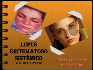 LUPUS
Eritematoso
 Sistémico
 Mi 3 – dRA. Alvarez
 