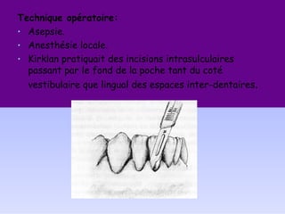 Technique opératoire:
• Asepsie.
• Anesthésie locale.
• Kirklan pratiquait des incisions intrasulculaires
passant par le fond de la poche tant du coté
vestibulaire que lingual des espaces inter-dentaires.
 