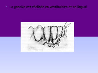 • La gencive est réclinée en vestibulaire et en lingual.
 